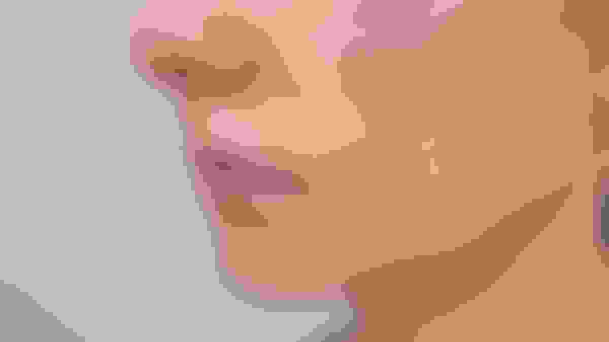 Rosacea on cheek