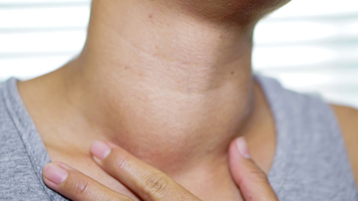 Goiter on neck