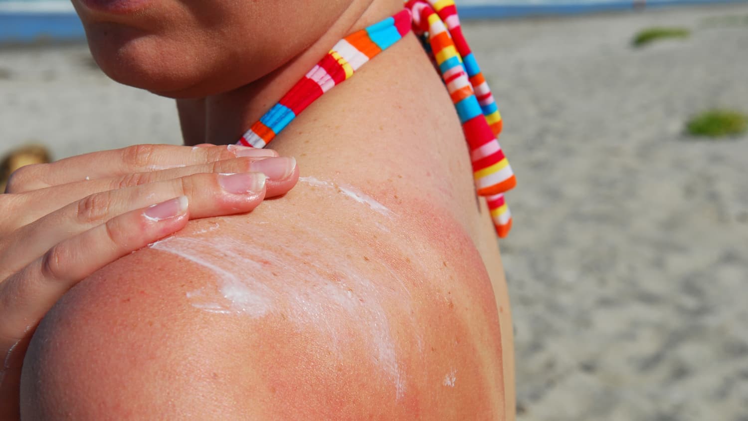 Sunburn treatment clearance