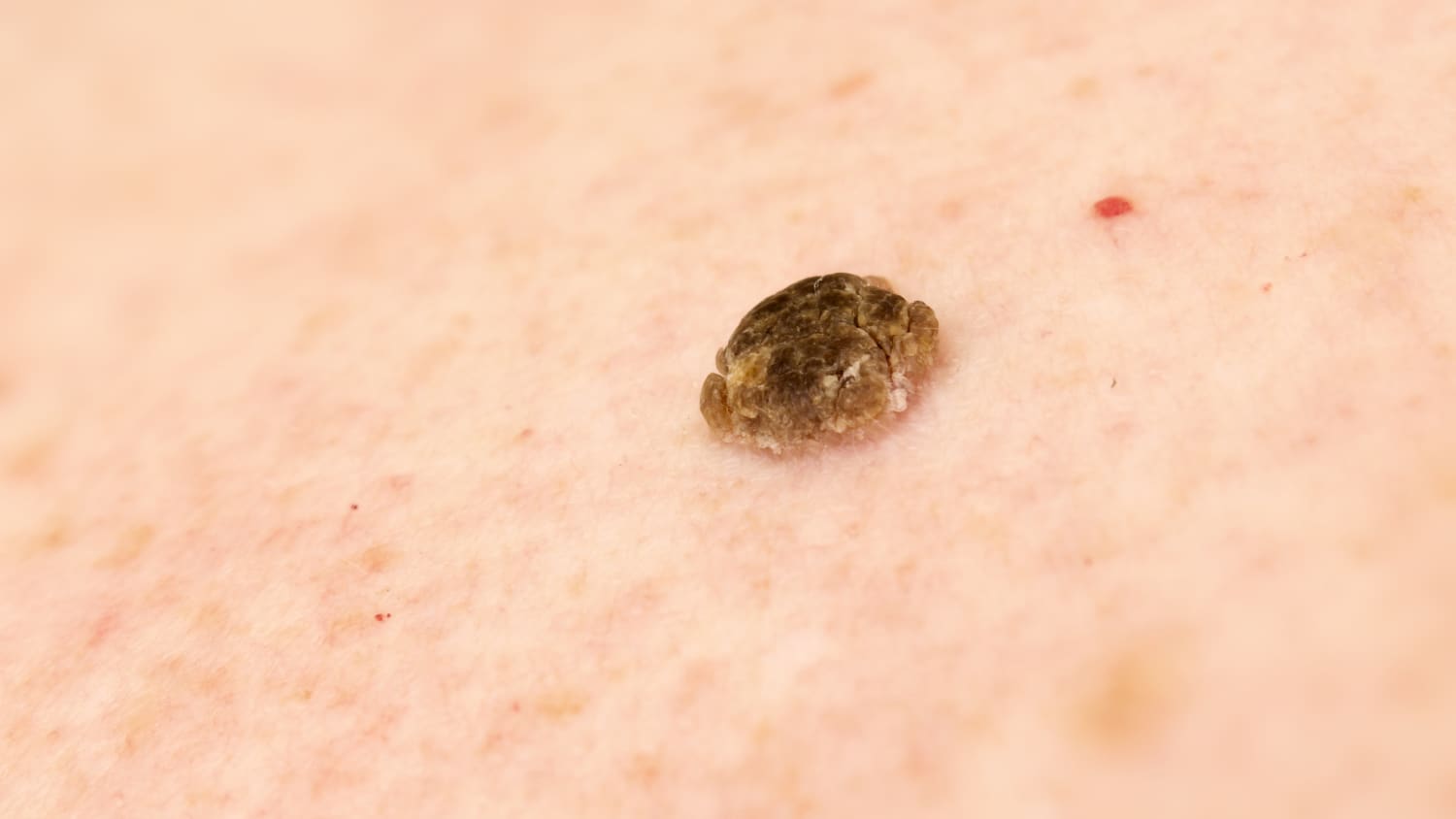 Seborrheic Keratosis on an individual's skin