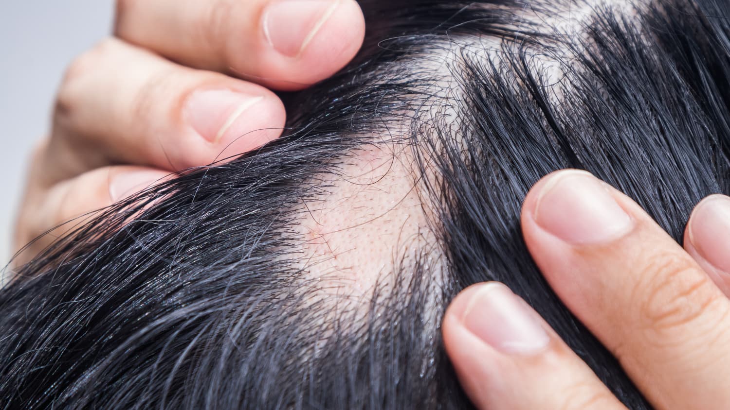 man with alopecia areata