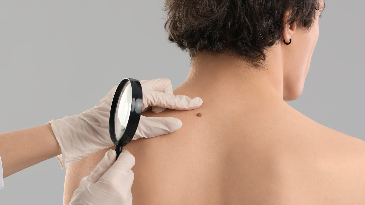 a dermatologic specialist inspecting a mole on a patient's back