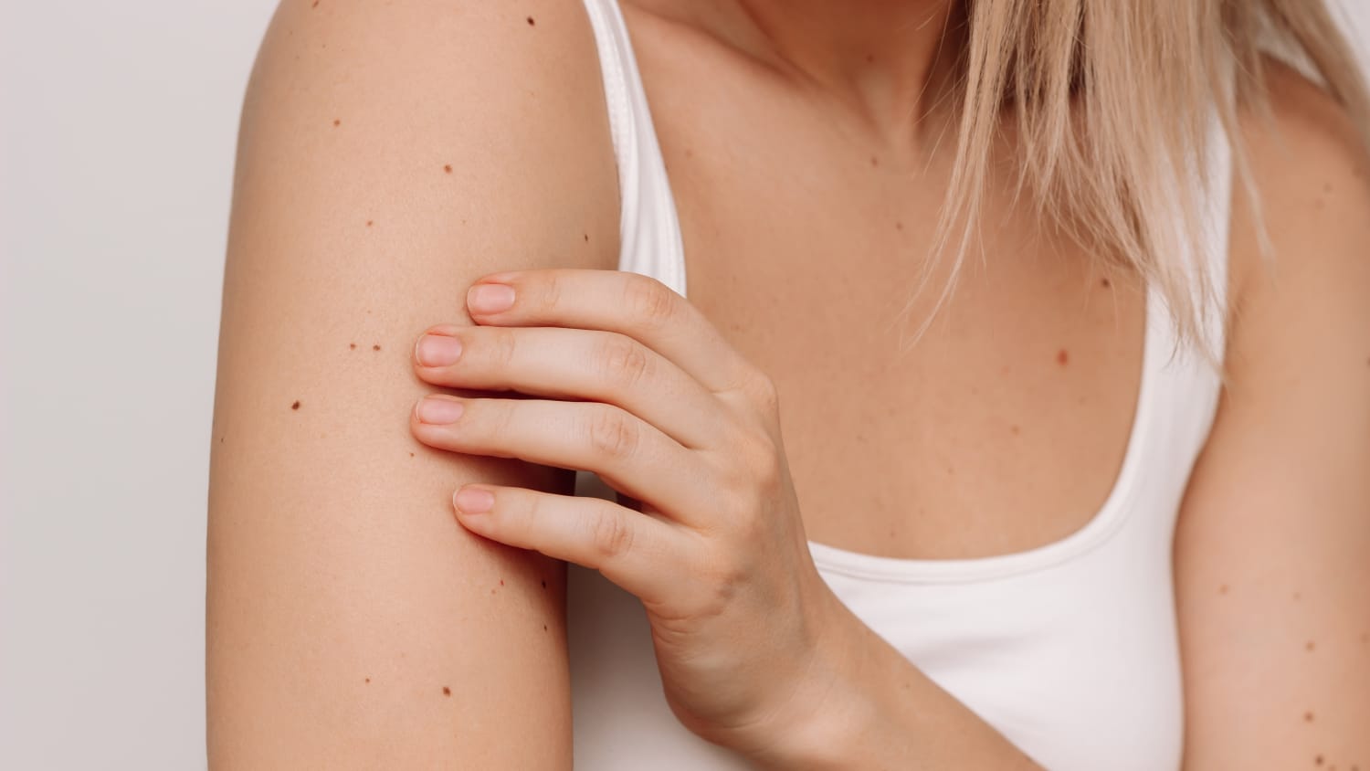Melanocytic Nevi (Moles) on skin