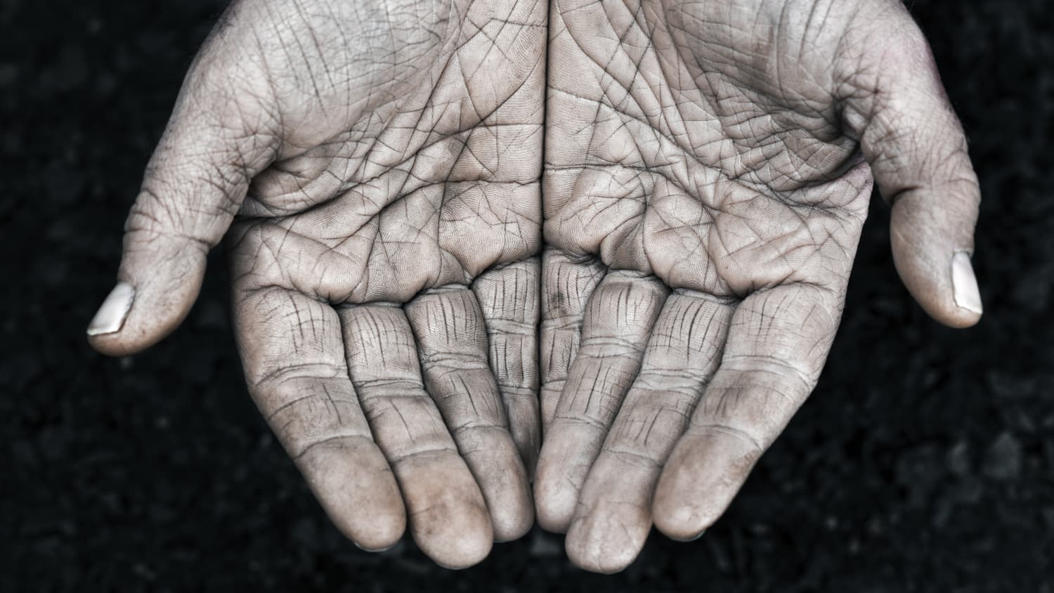 close-up of person's hands, possibly indicating hand ischemia