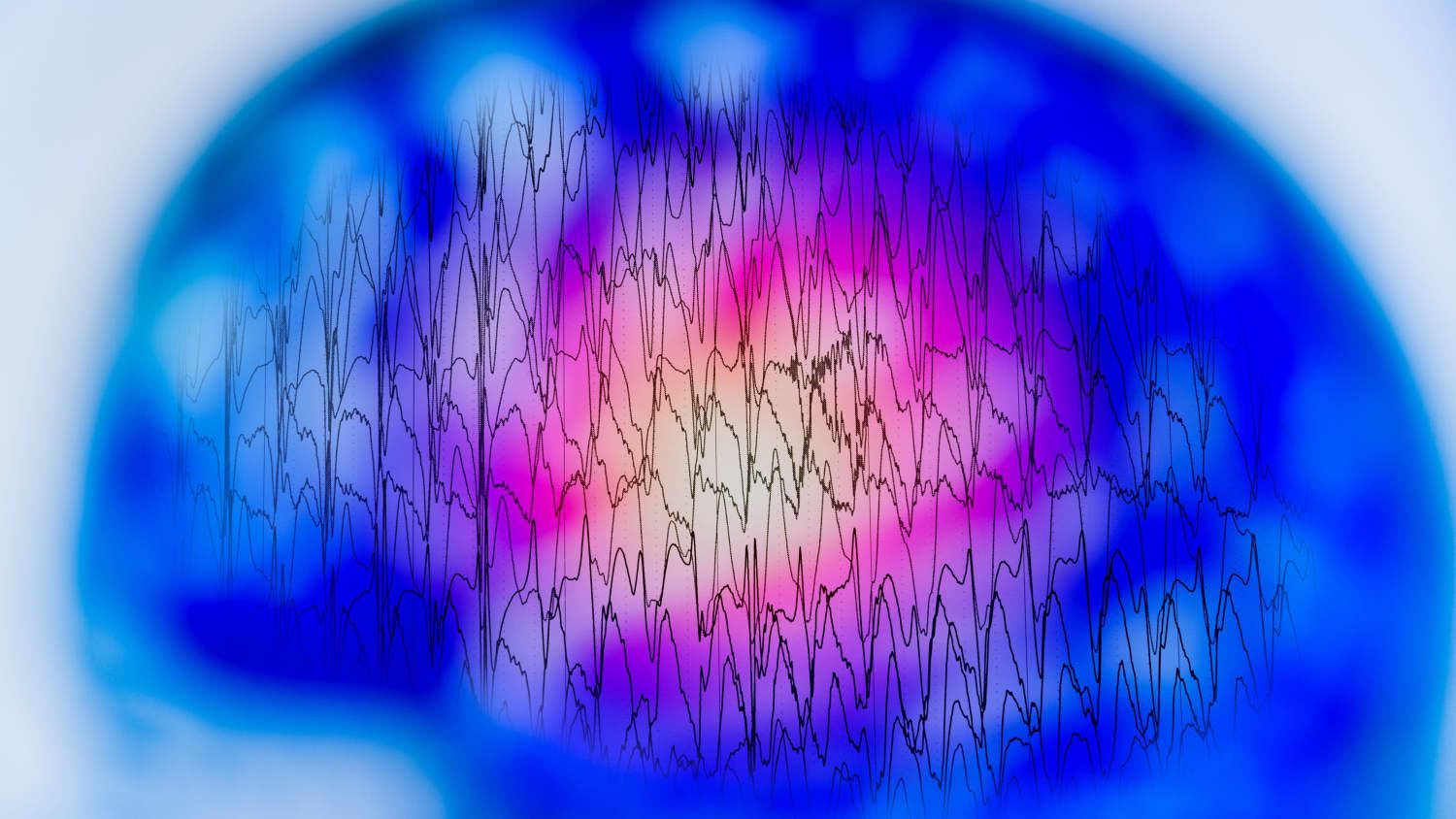 Electroencephalogram, EEG, which can be used to detect seizures associated with epilepsy