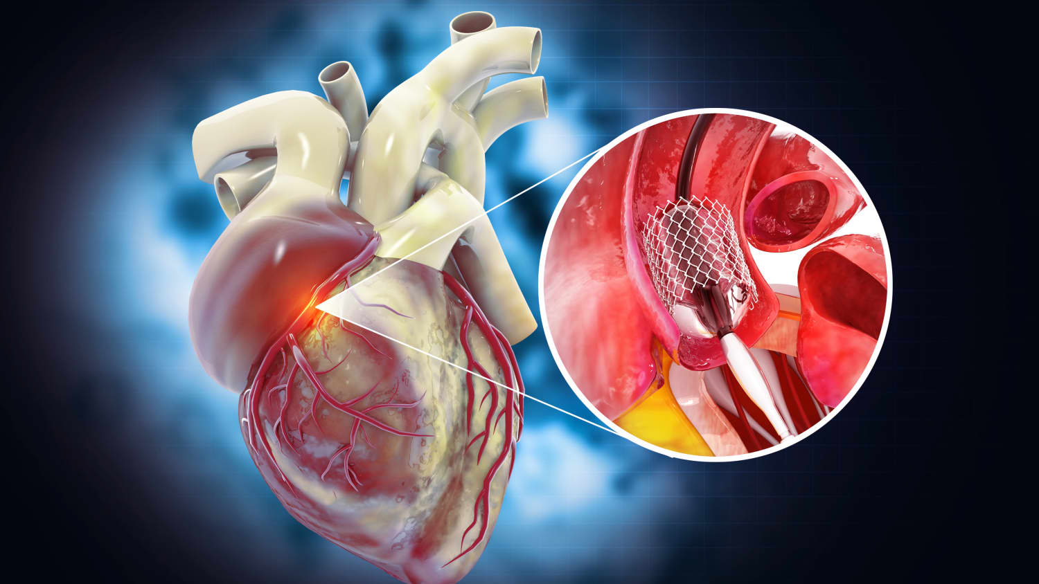 Stent in Heart Valve