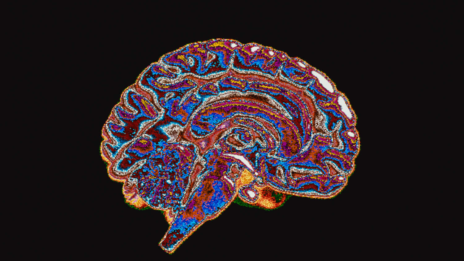 scan of a brain, representative of issues related to normal pressure hydrocephalus