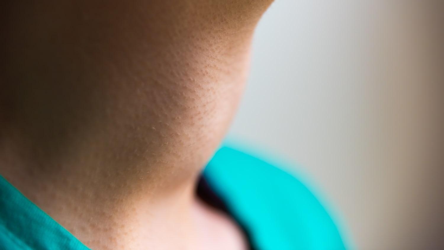Thyroid affected by Graves' Disease