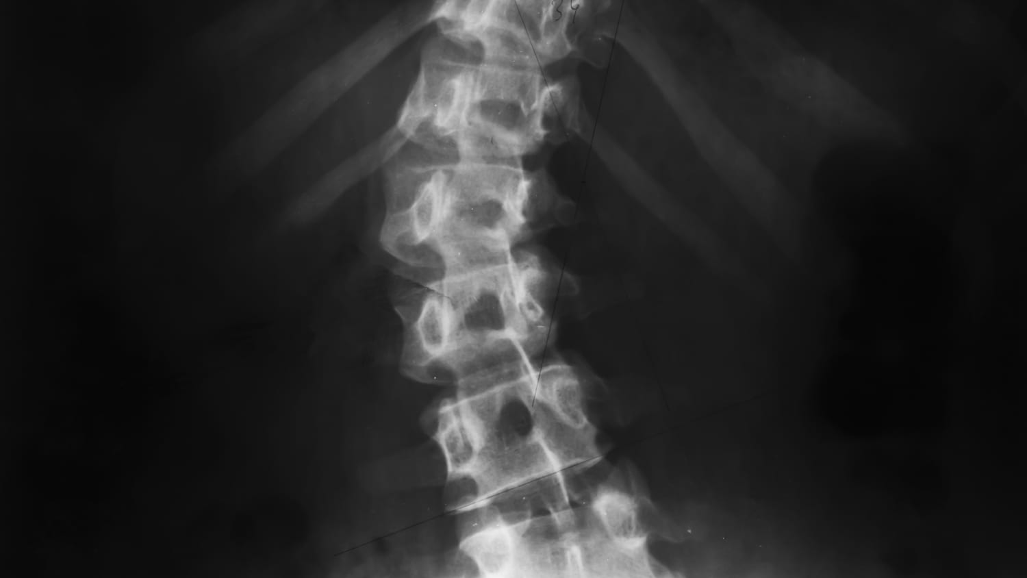 an x-ray of Halo-Gravity Traction