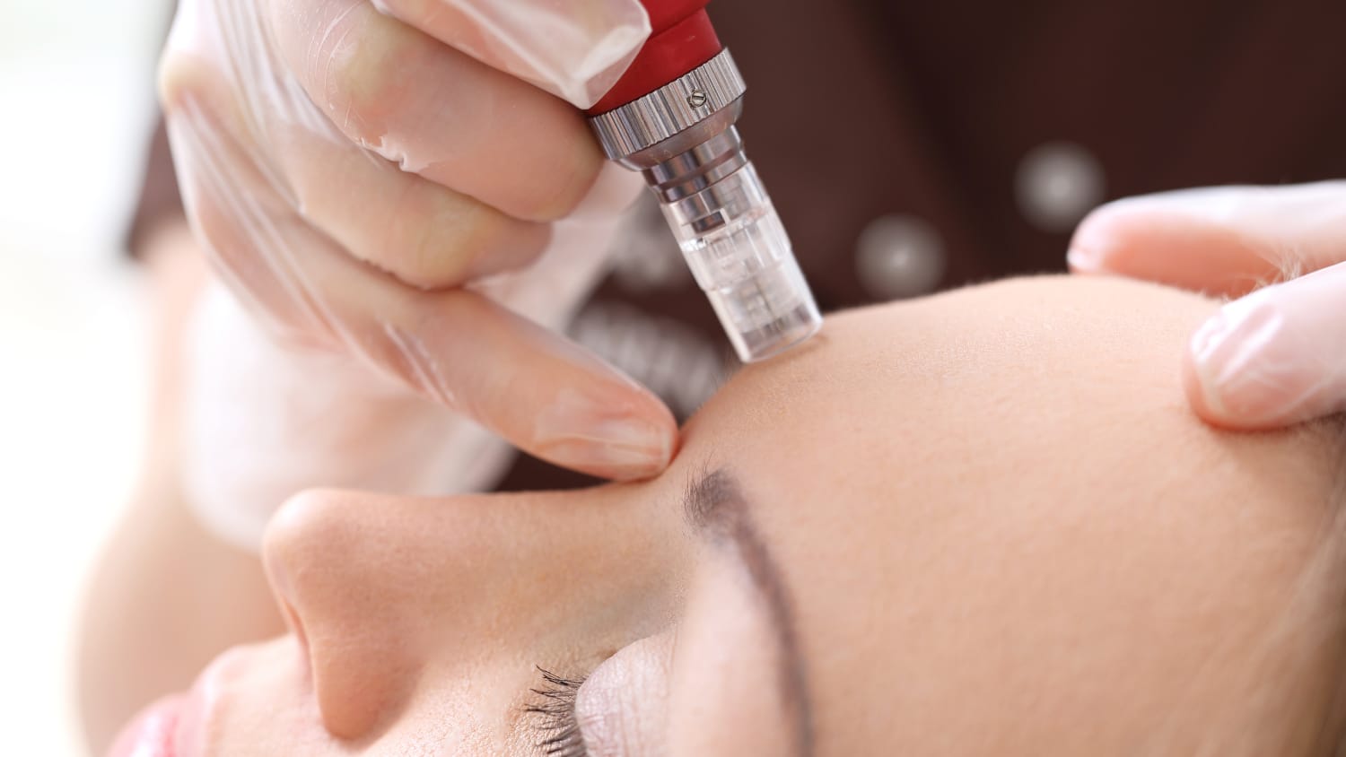 A woman undergoing microneedling