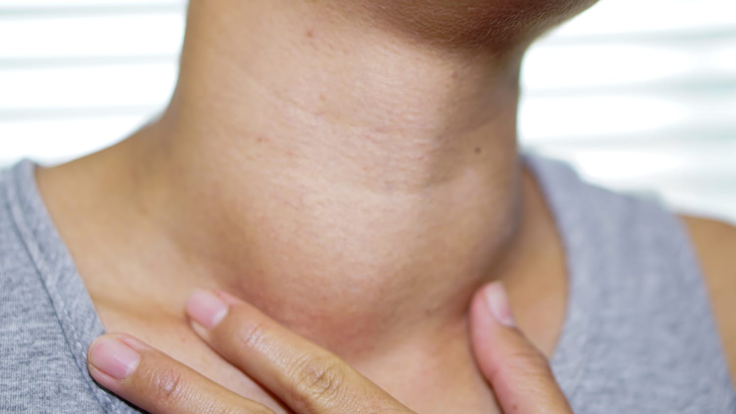 Goiter on neck