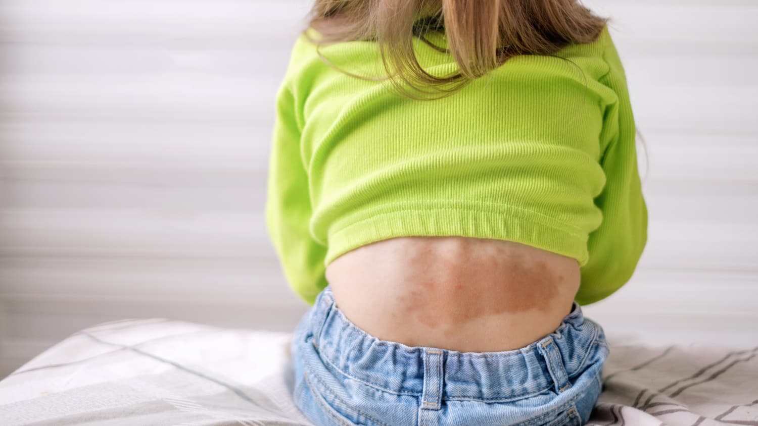 child with vascular malformation on her back