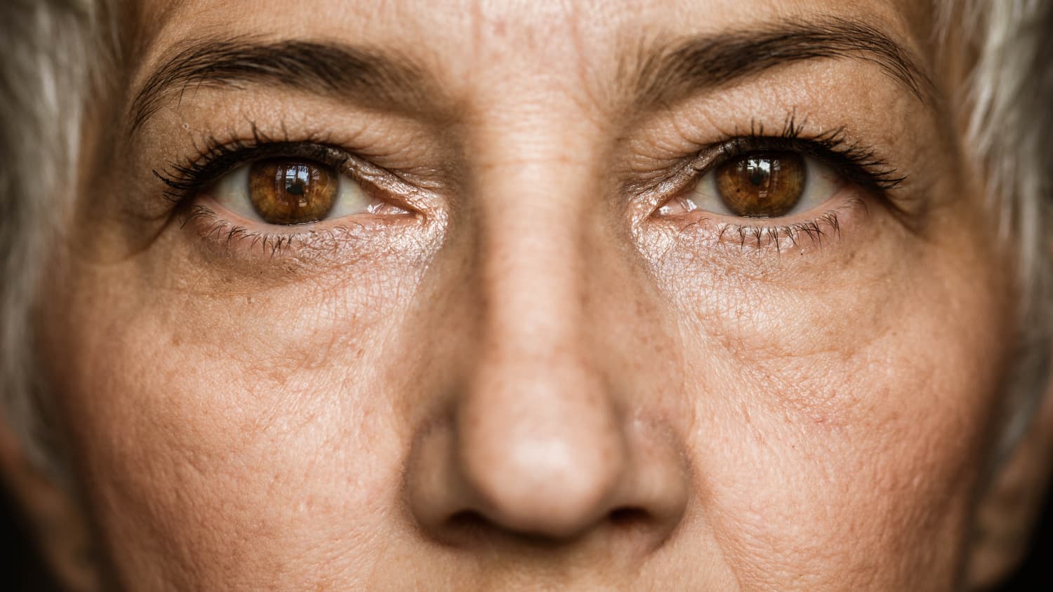 closeup of woman's eyes after receiving cataract surgery