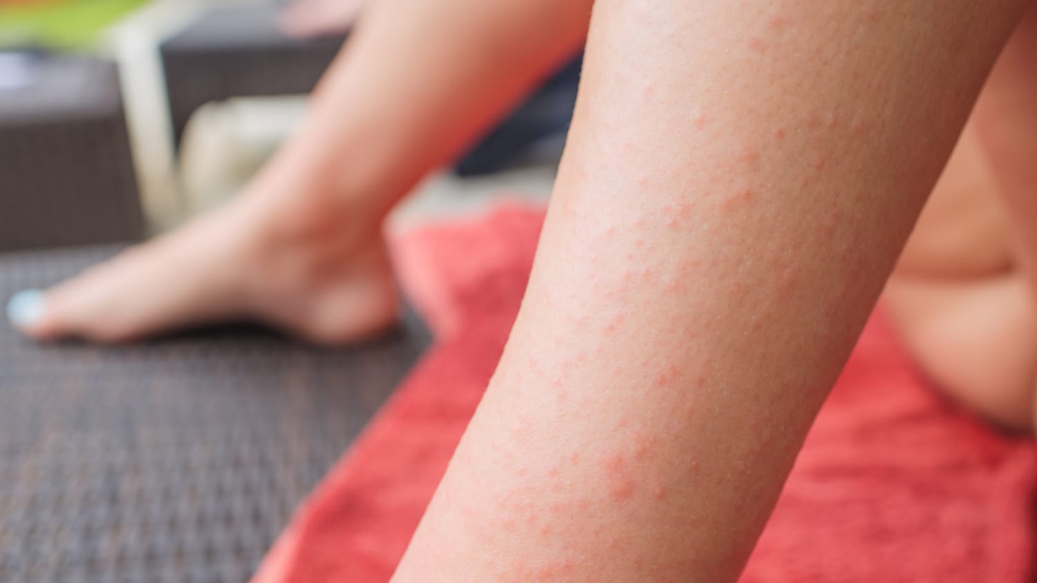 Dermatitis herpetiformis on leg
