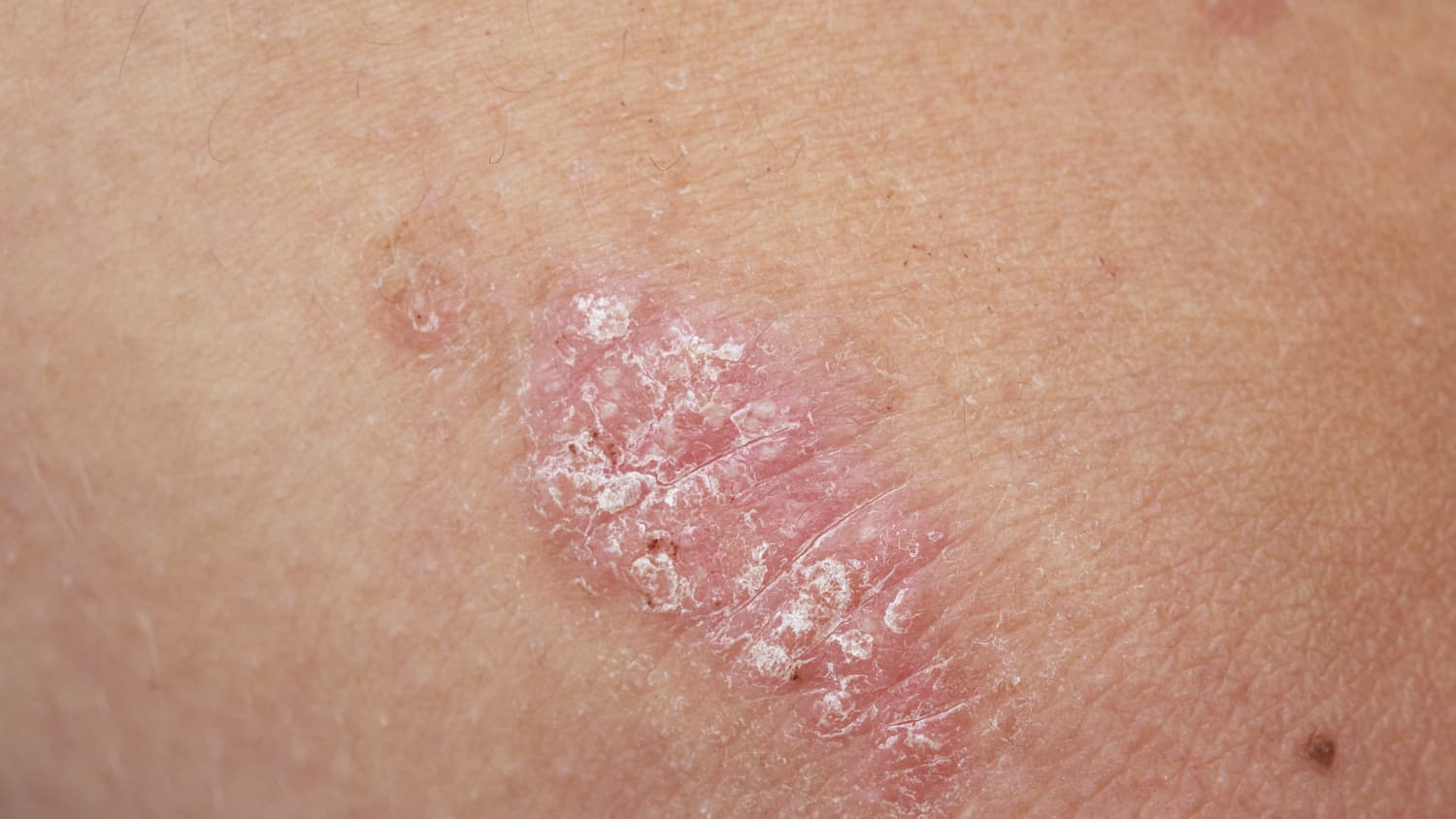 Psoriasis of the arm