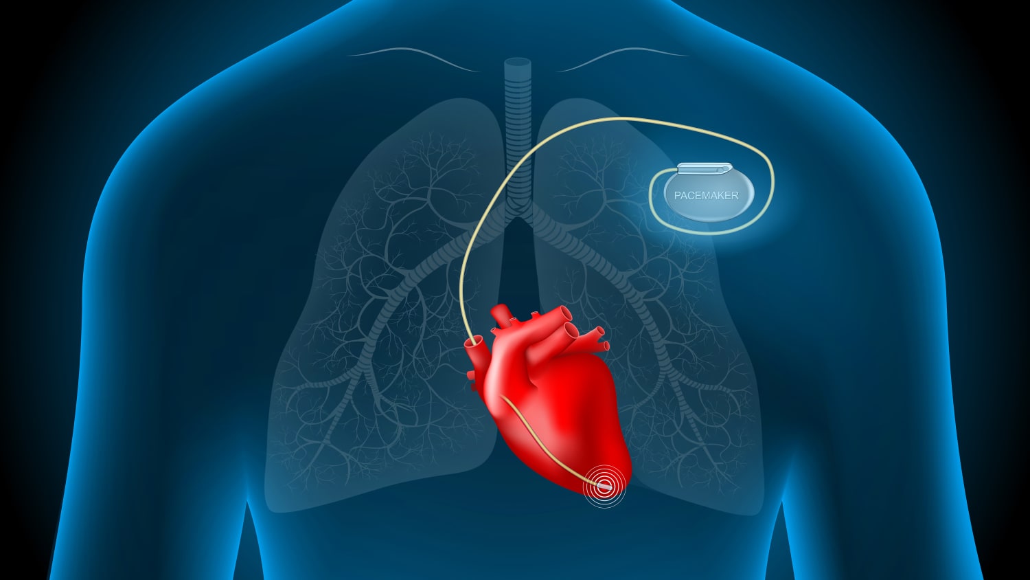 an implanted Cardiac Pacemaker