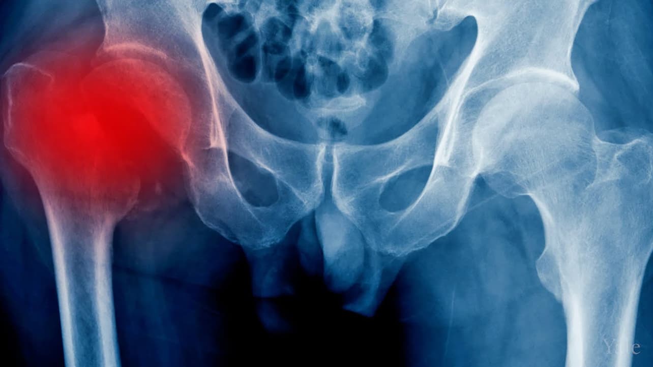 An X-ray image of a pelvis and upper femurs with a deep red circle overlaid on the left hip joint