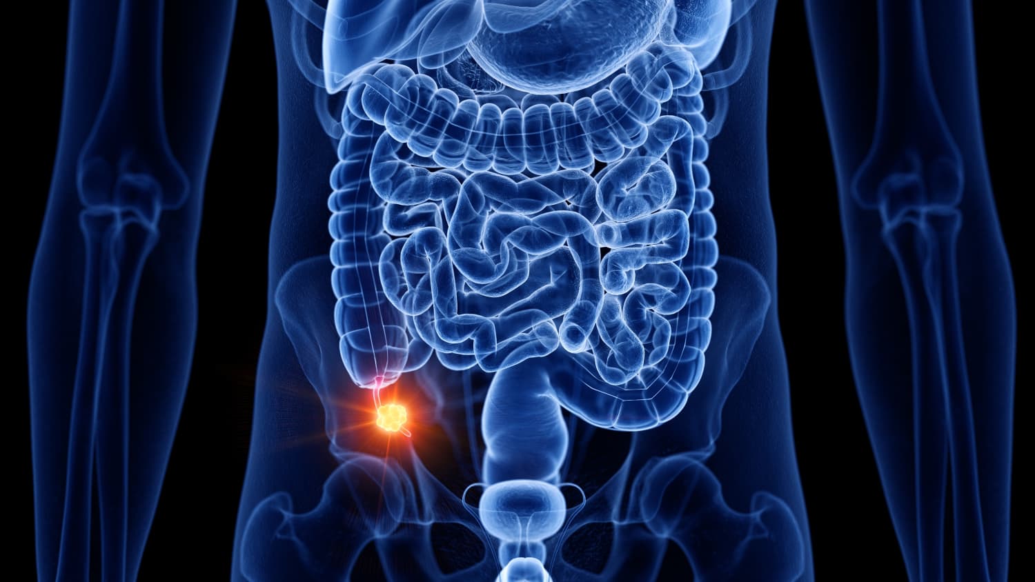 Appendix Cancer