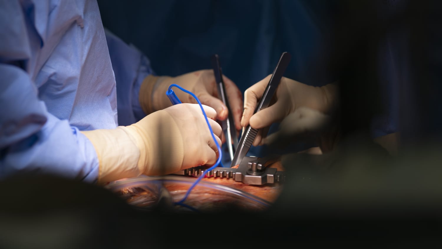 surgeons completing Reoperative Heart Surgery