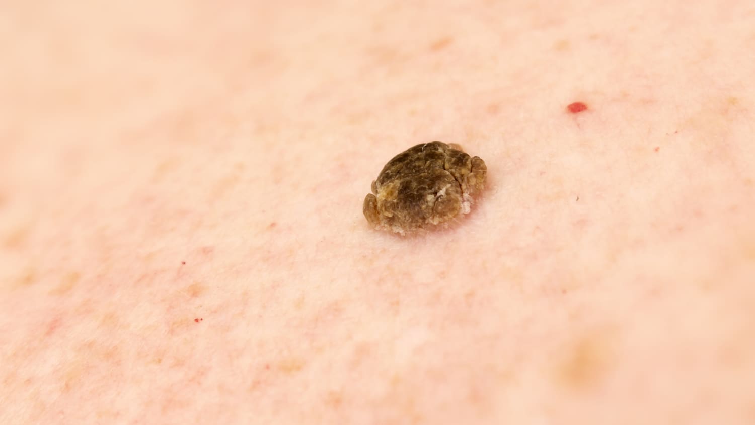 Seborrheic Keratosis on an individual's skin