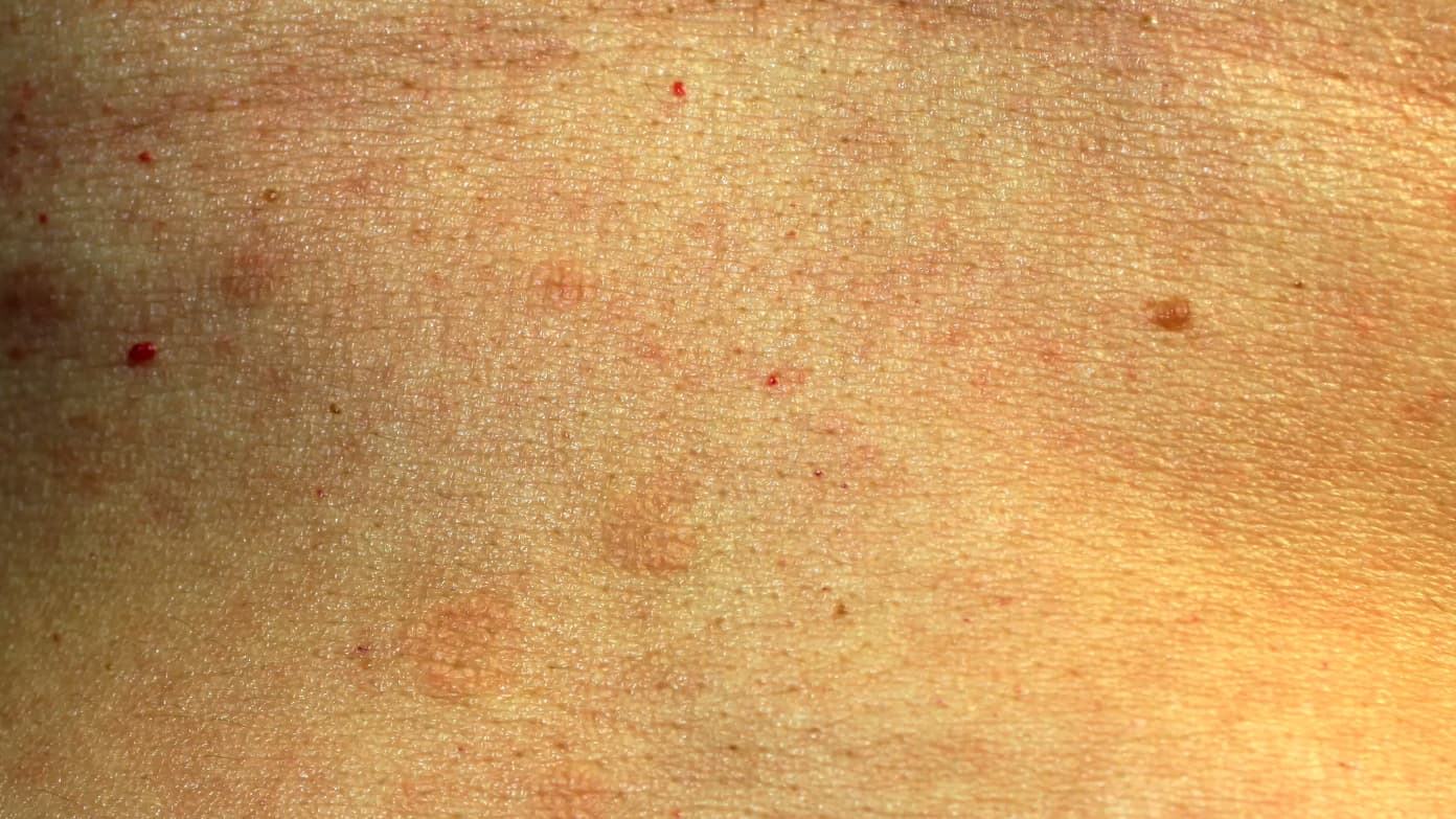 Lichen Planus on skin