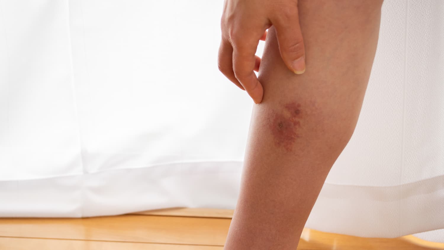 Cellulitis on leg