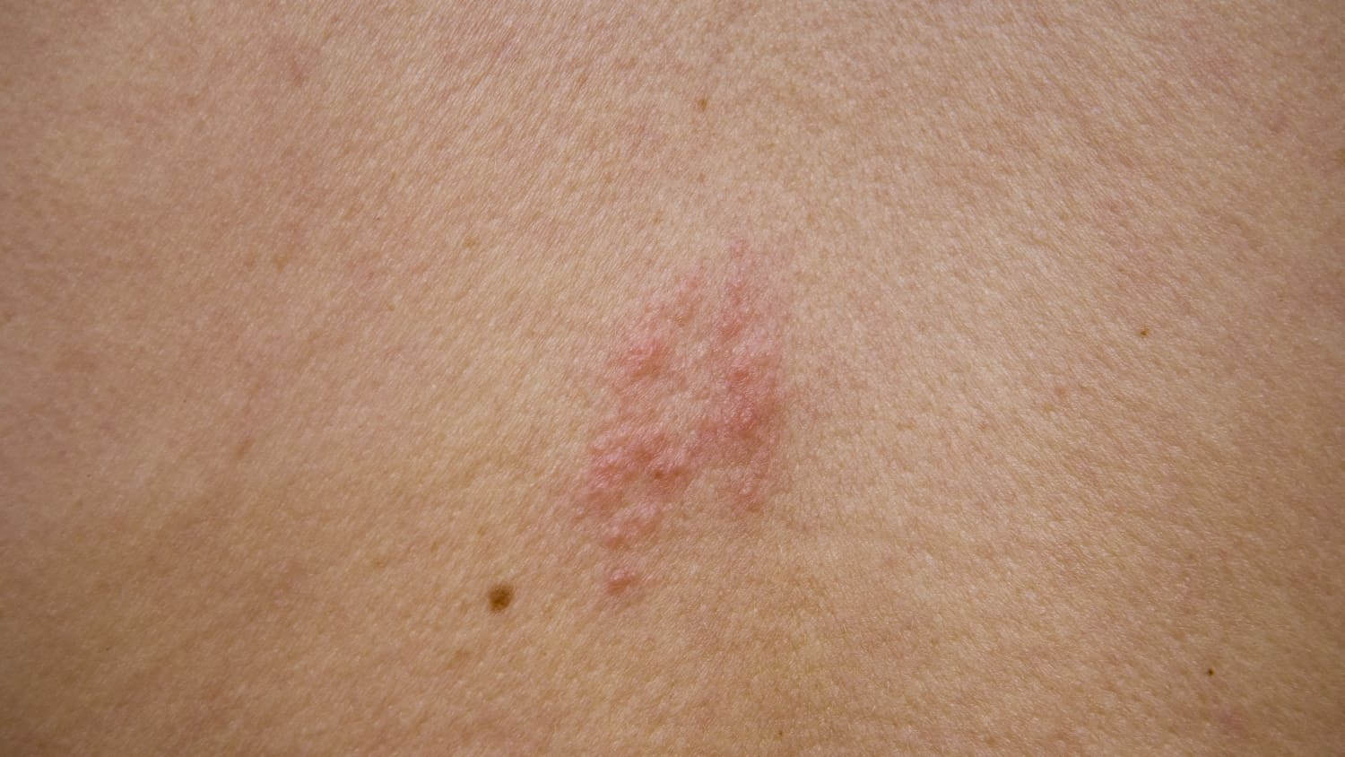 shingles on an individual's back