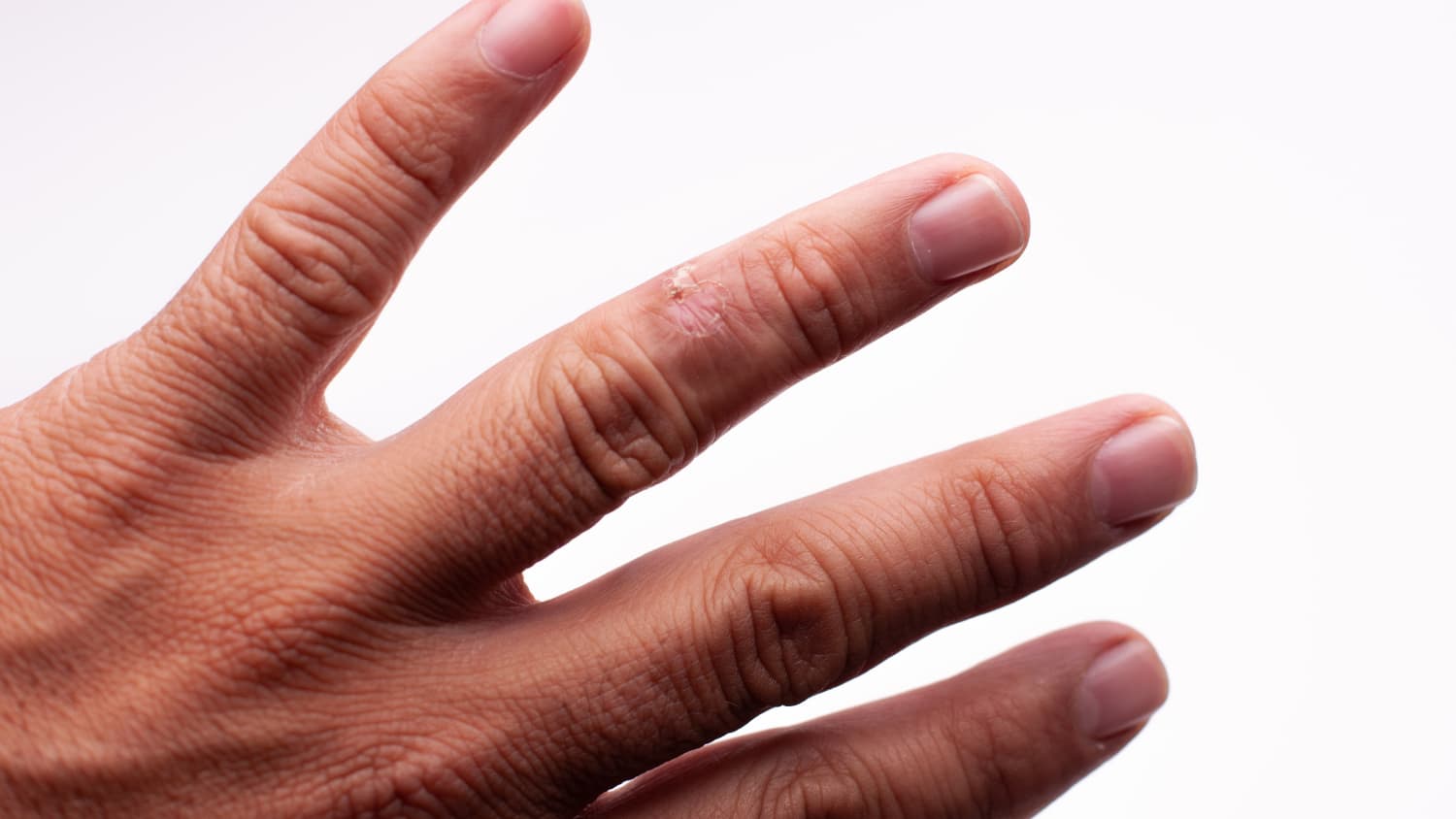 hand with plaque scleroderma 