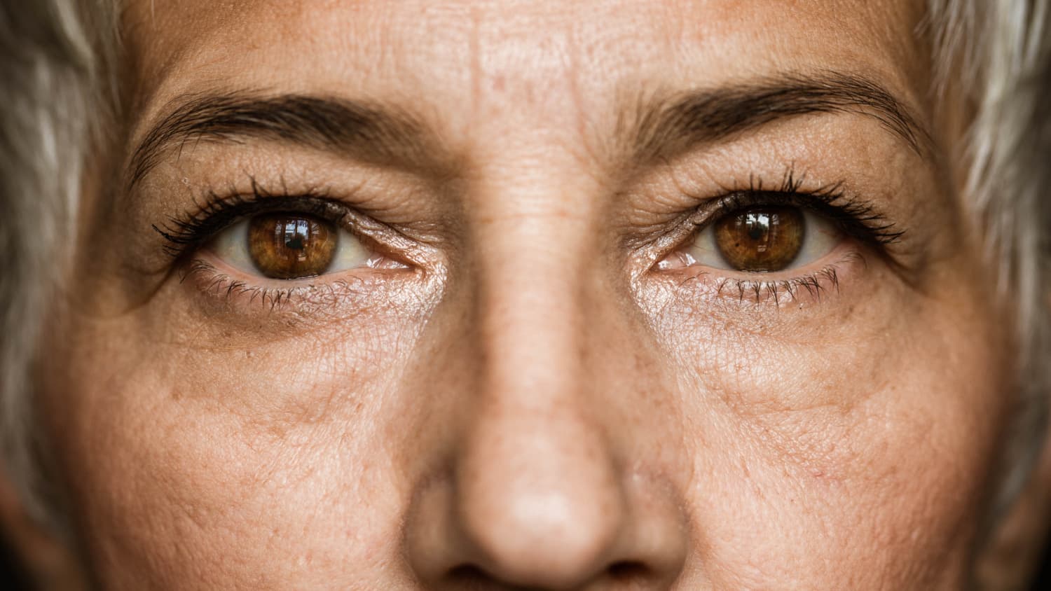 closeup of woman's eyes after receiving cataract surgery