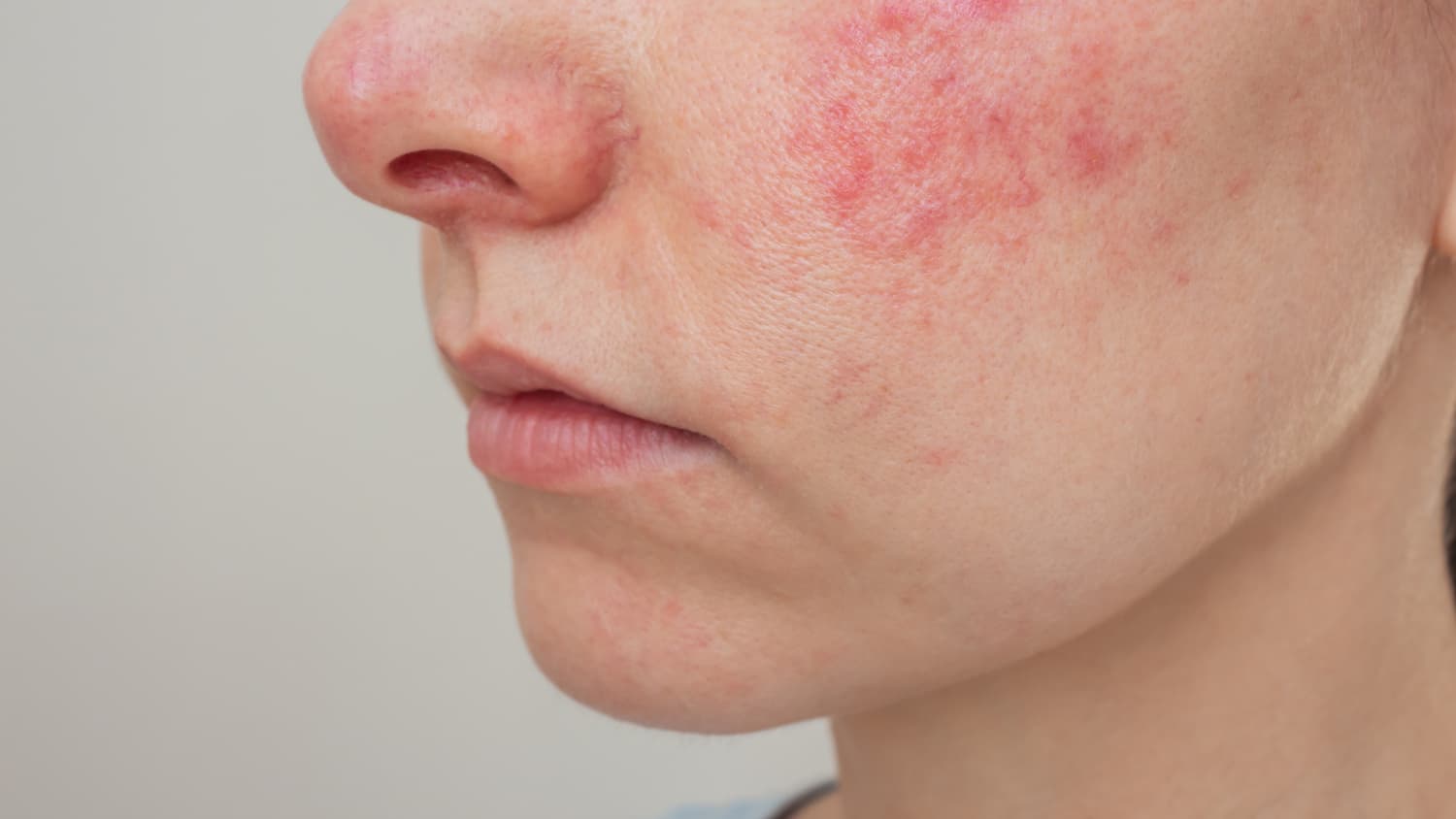 Rosacea on cheek