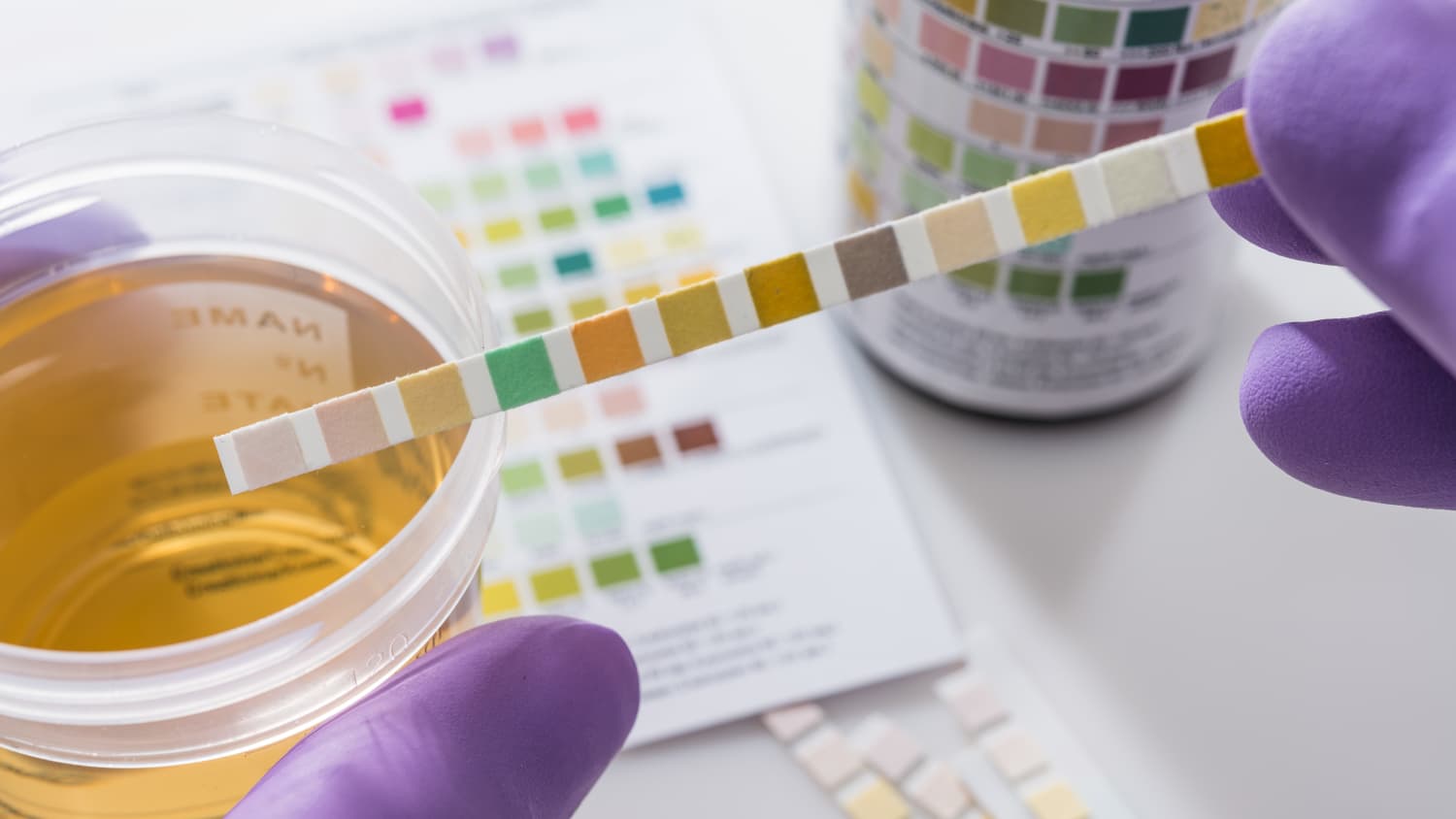 Urinalysis Test Strips and Sample
