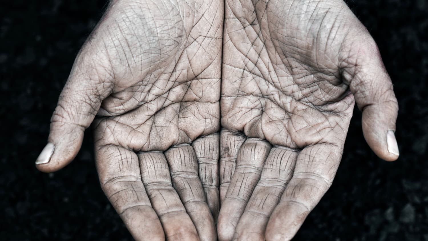 close-up of person's hands, possibly indicating hand ischemia