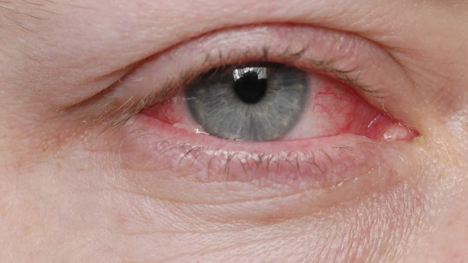 closeup of an eye with conjunctivitis