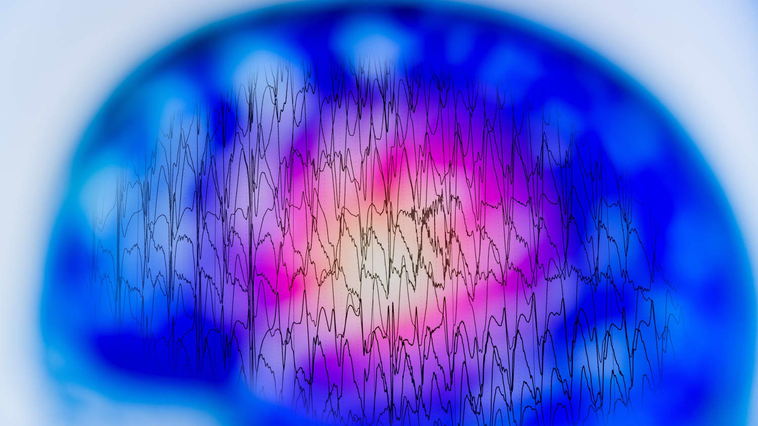 Electroencephalogram, EEG, which can be used to detect seizures associated with epilepsy