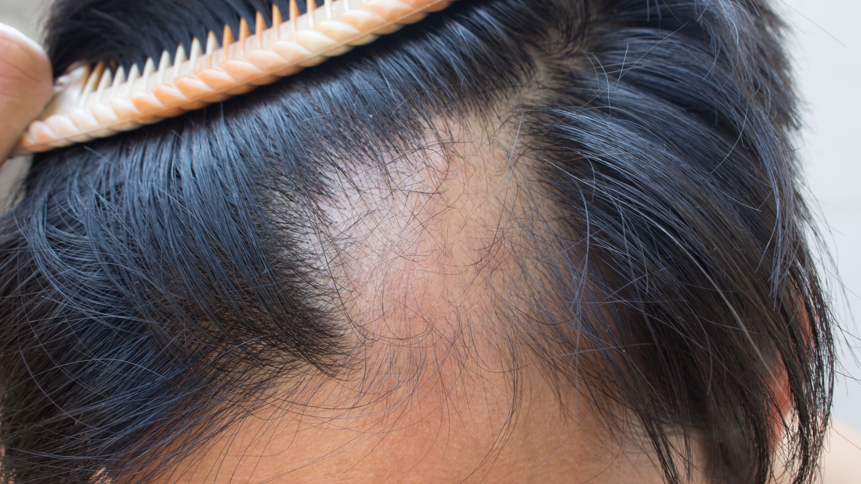 Someone with alopecia combing back black hair to reveal a bald spot.