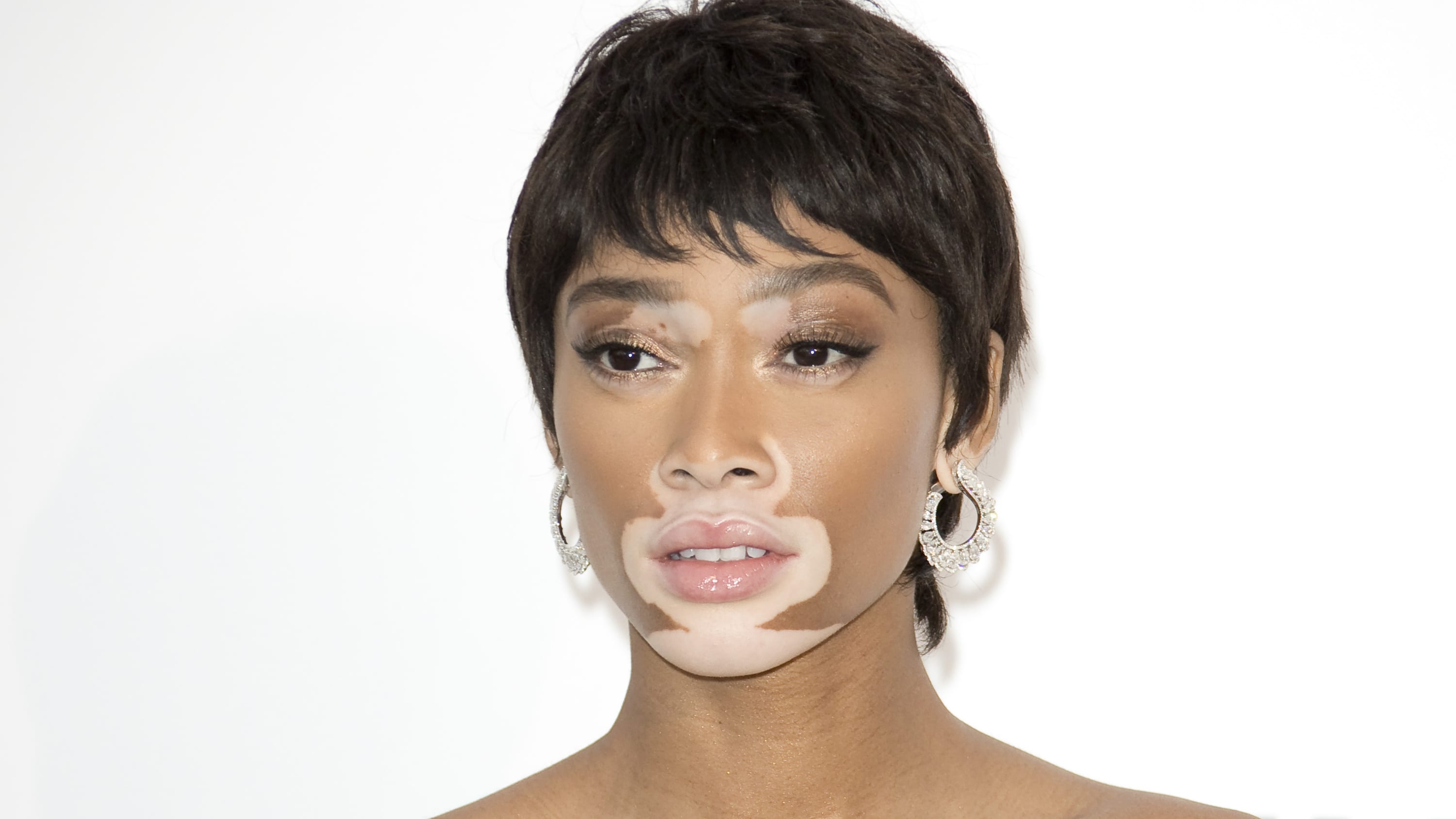 A woman with vitiligo poses for the camera. The vitiligo is a noticeably lighter color than her normal skin color.