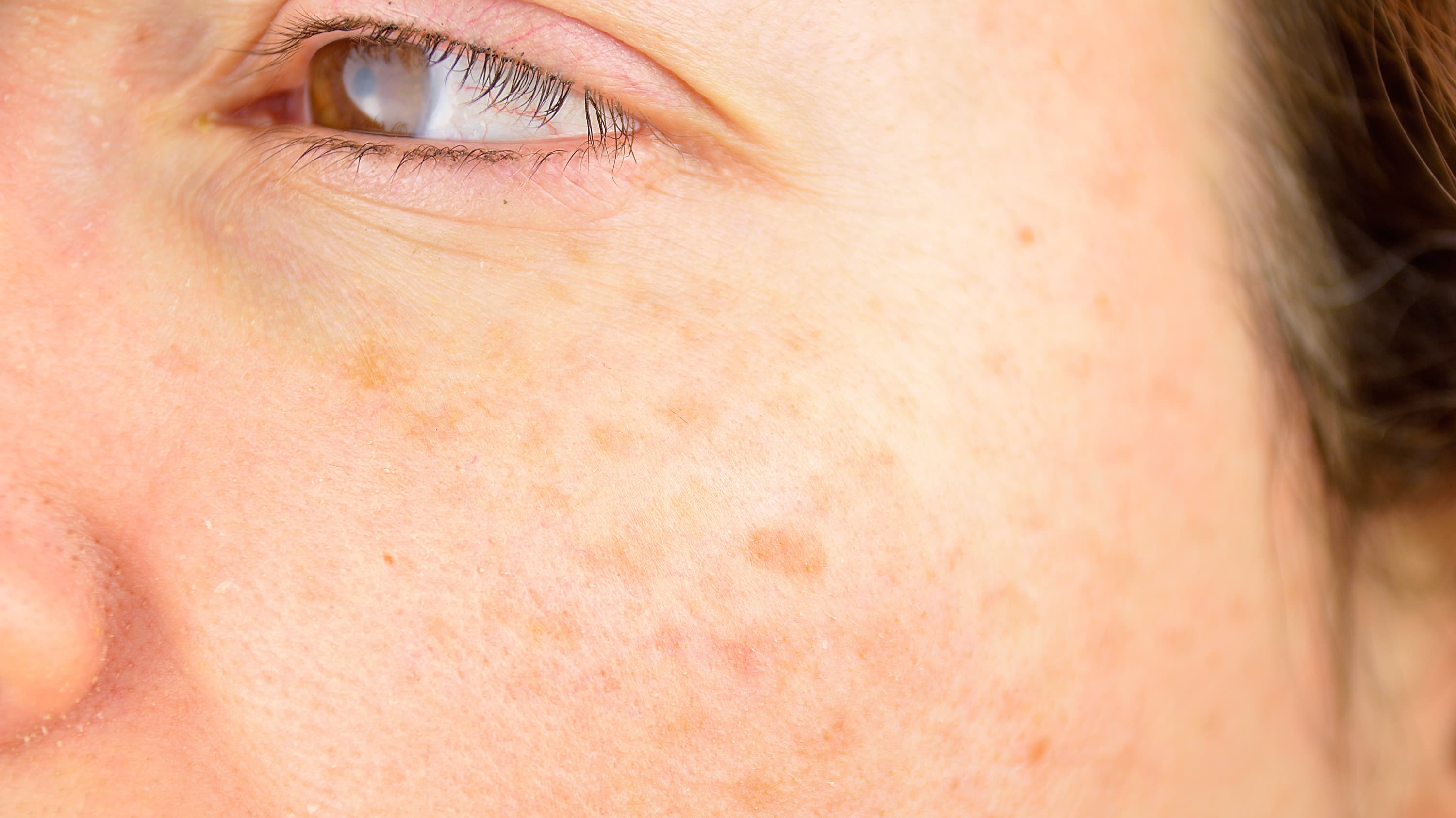 woman cheek with liver spot causes by sun damage