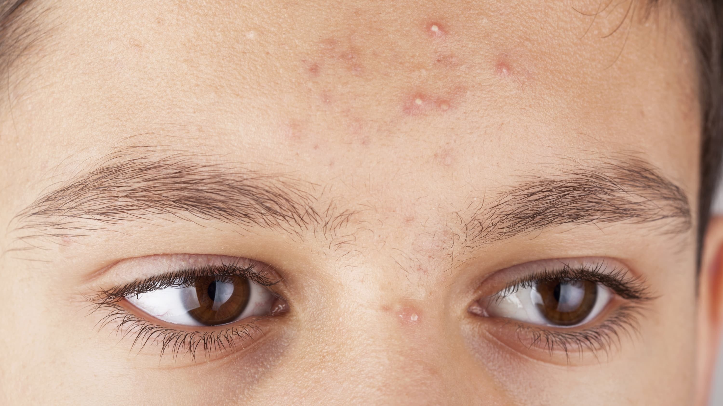 teenager with acne