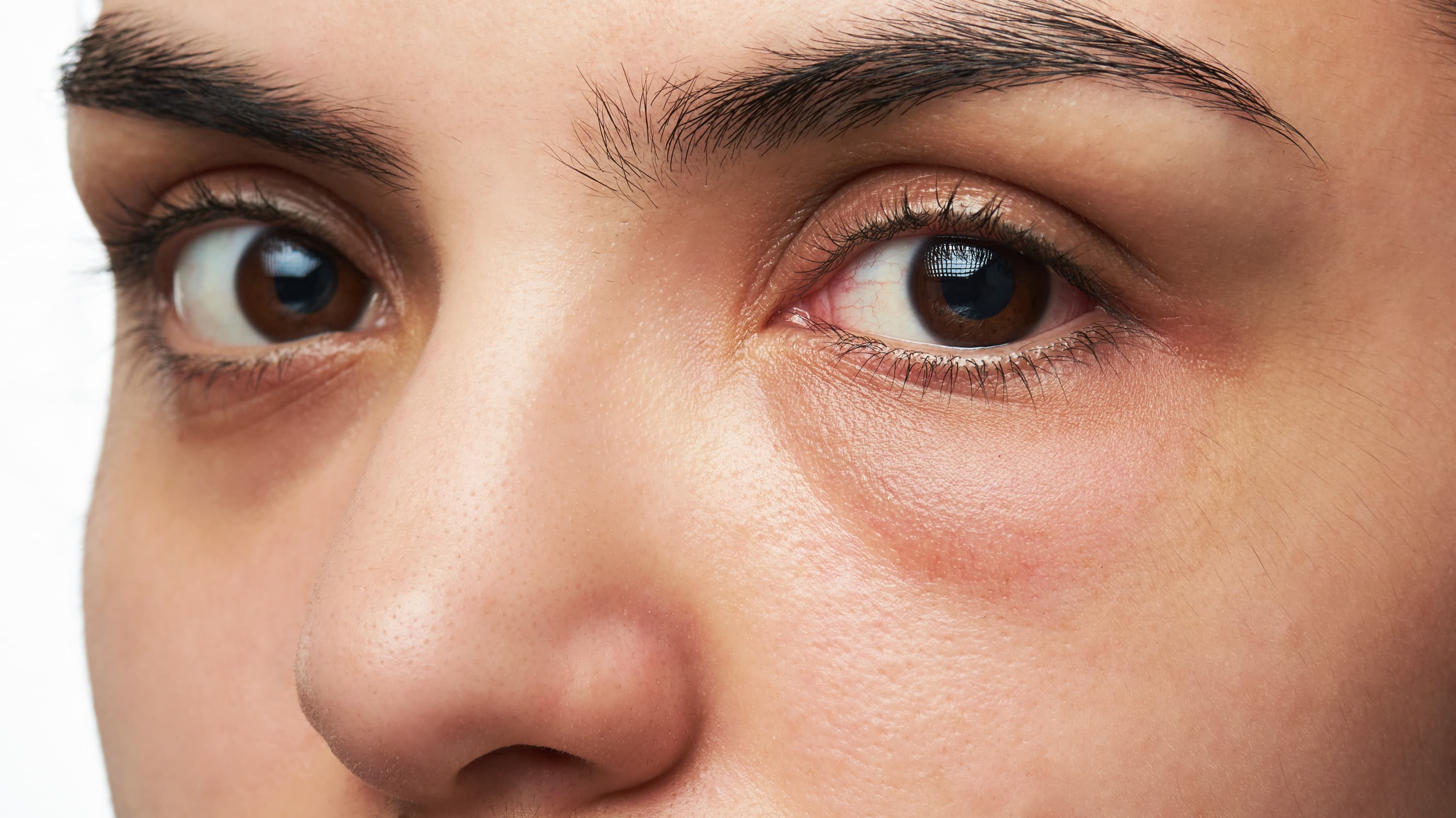 A close-up of a woman who possibly has a corneal abrasion