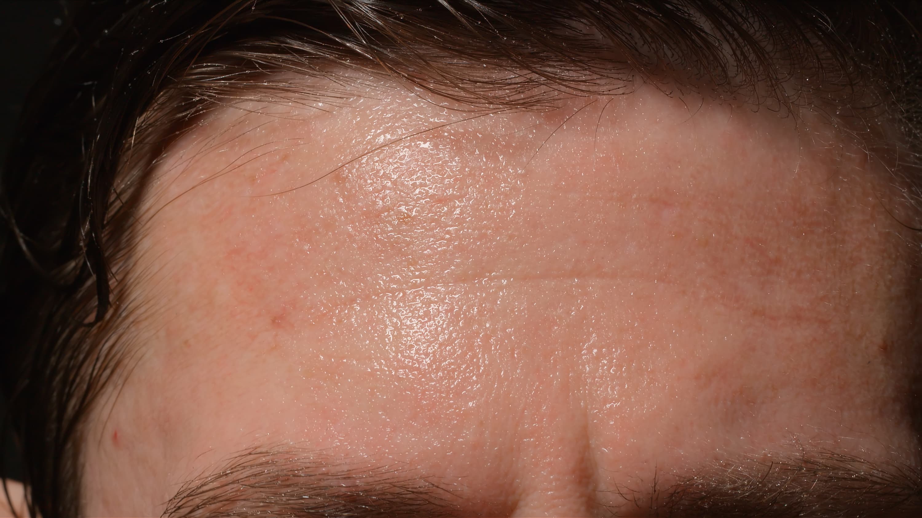 Close up of a man's sweaty forehead, possibly someone who has hyperhidrosis