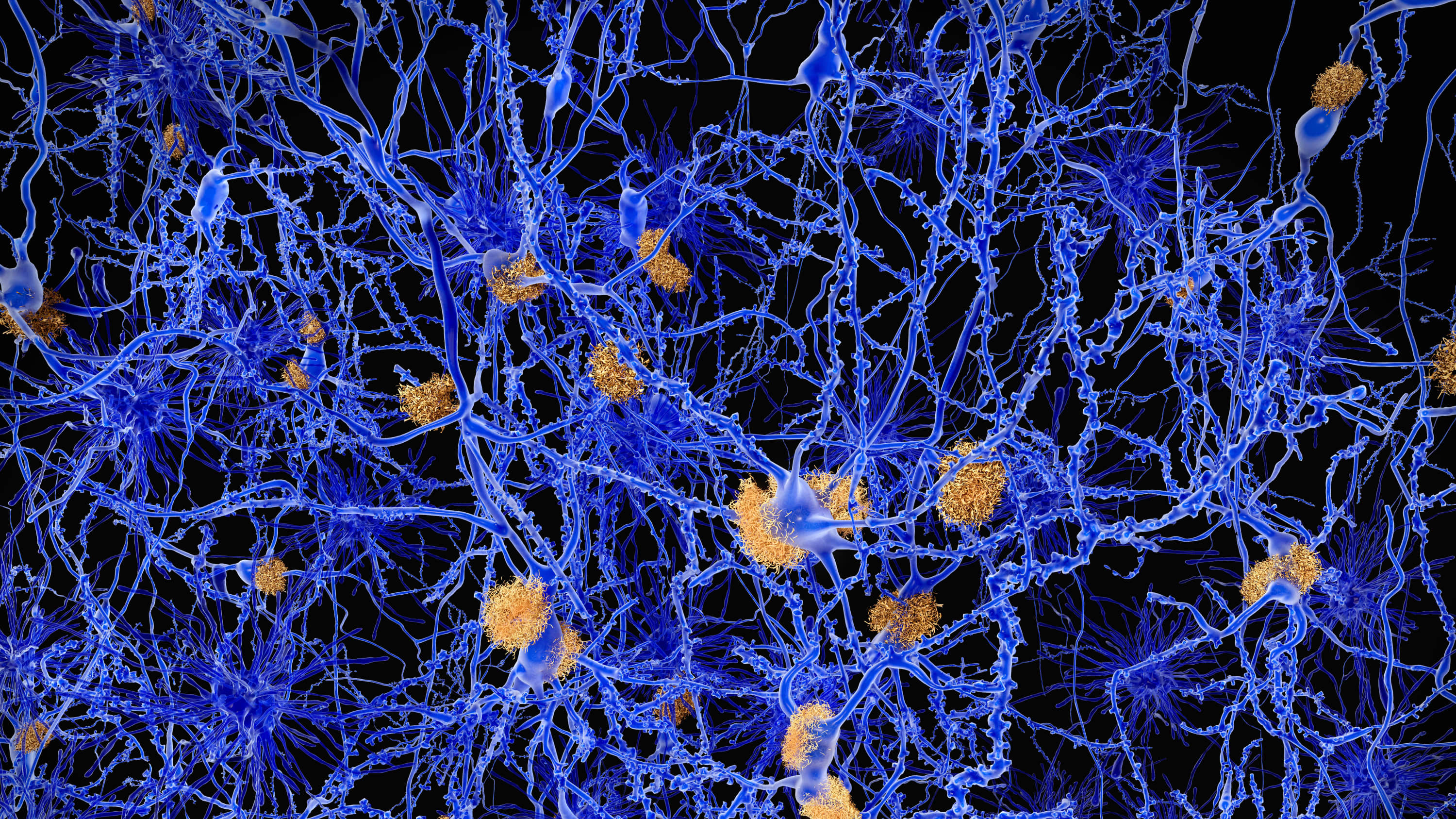Illustration of amyloid plaques, the characteristic feature of Alzheimer’s disease, among neurons.