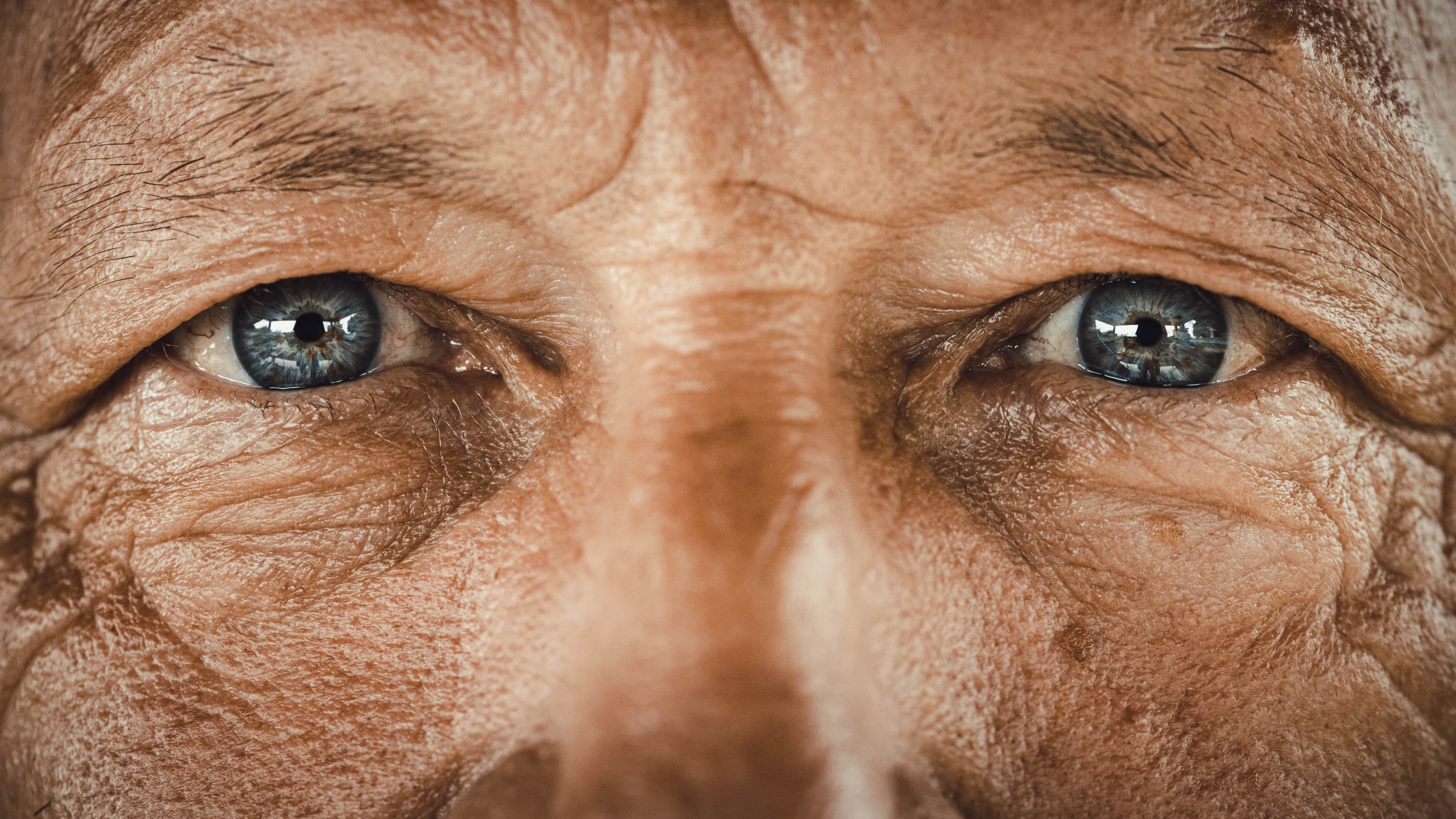 old man with blue eyes, possibly with eye cancer