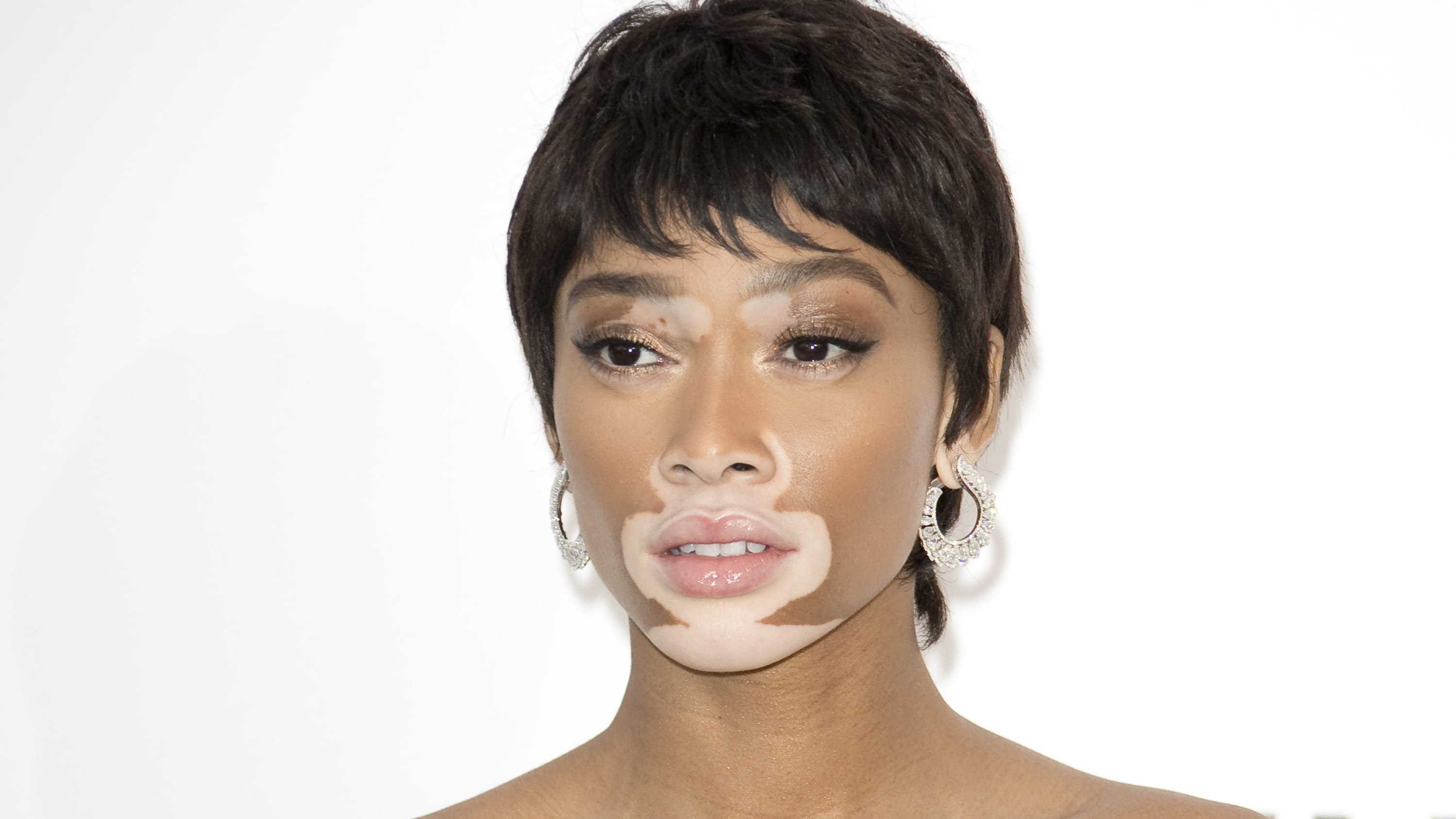 A woman with vitiligo poses for the camera. The vitiligo is a noticeably lighter color than her normal skin color.