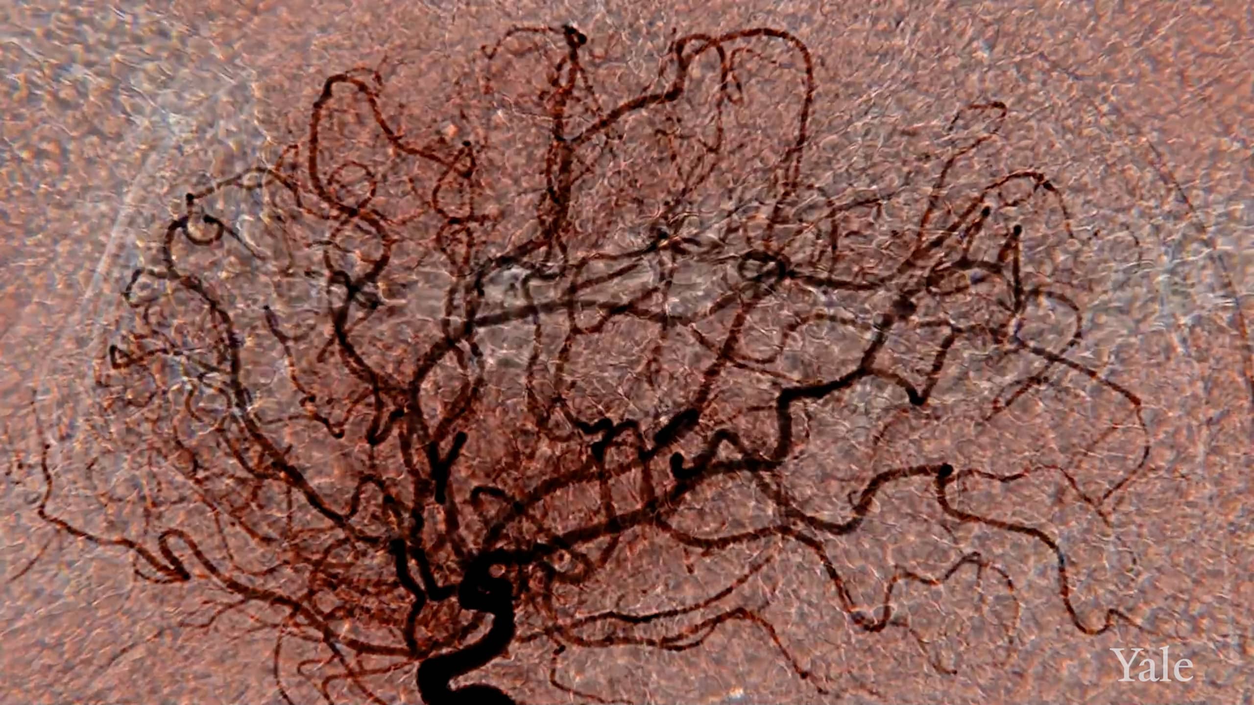 Medical imaging showing blood vessels in the brain with an overlay of red blood cells