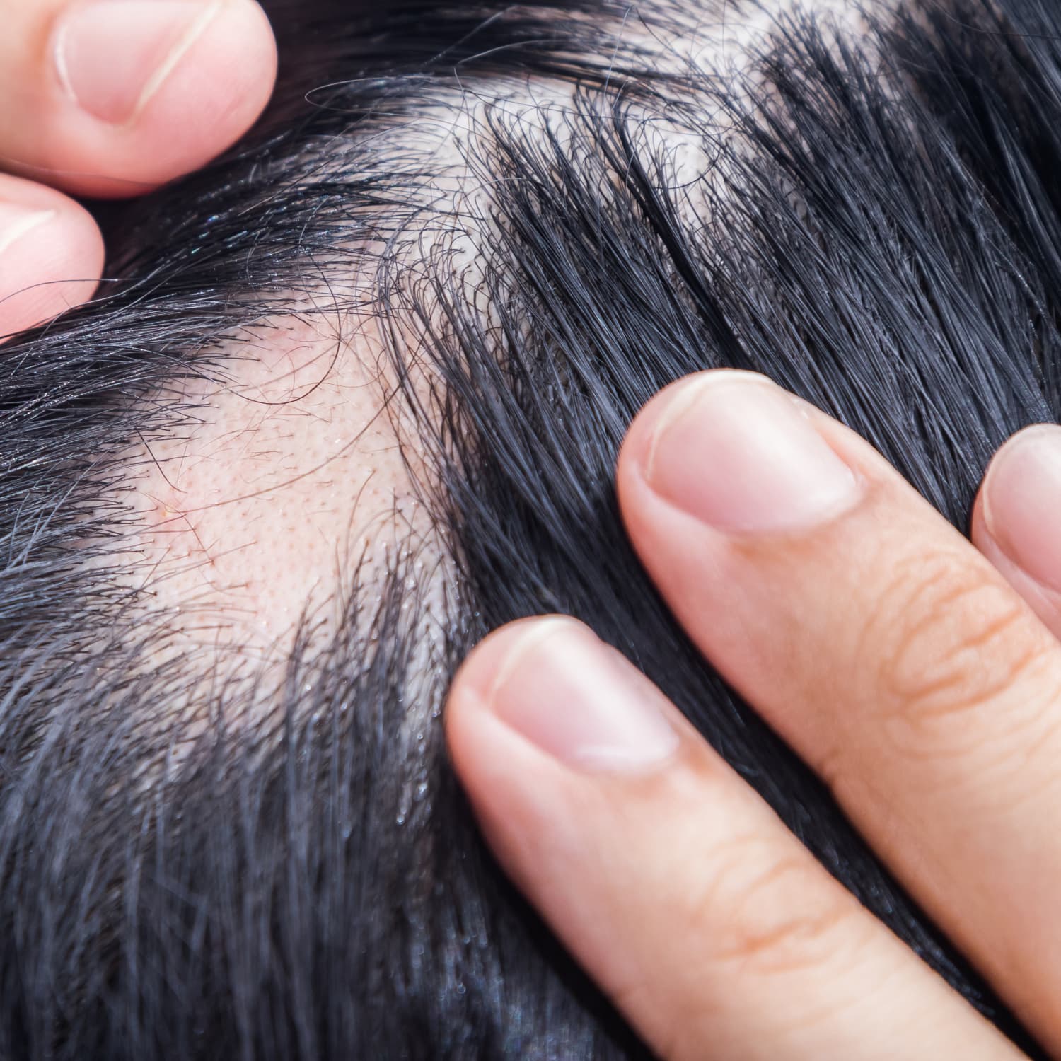 Cause top of alopecia