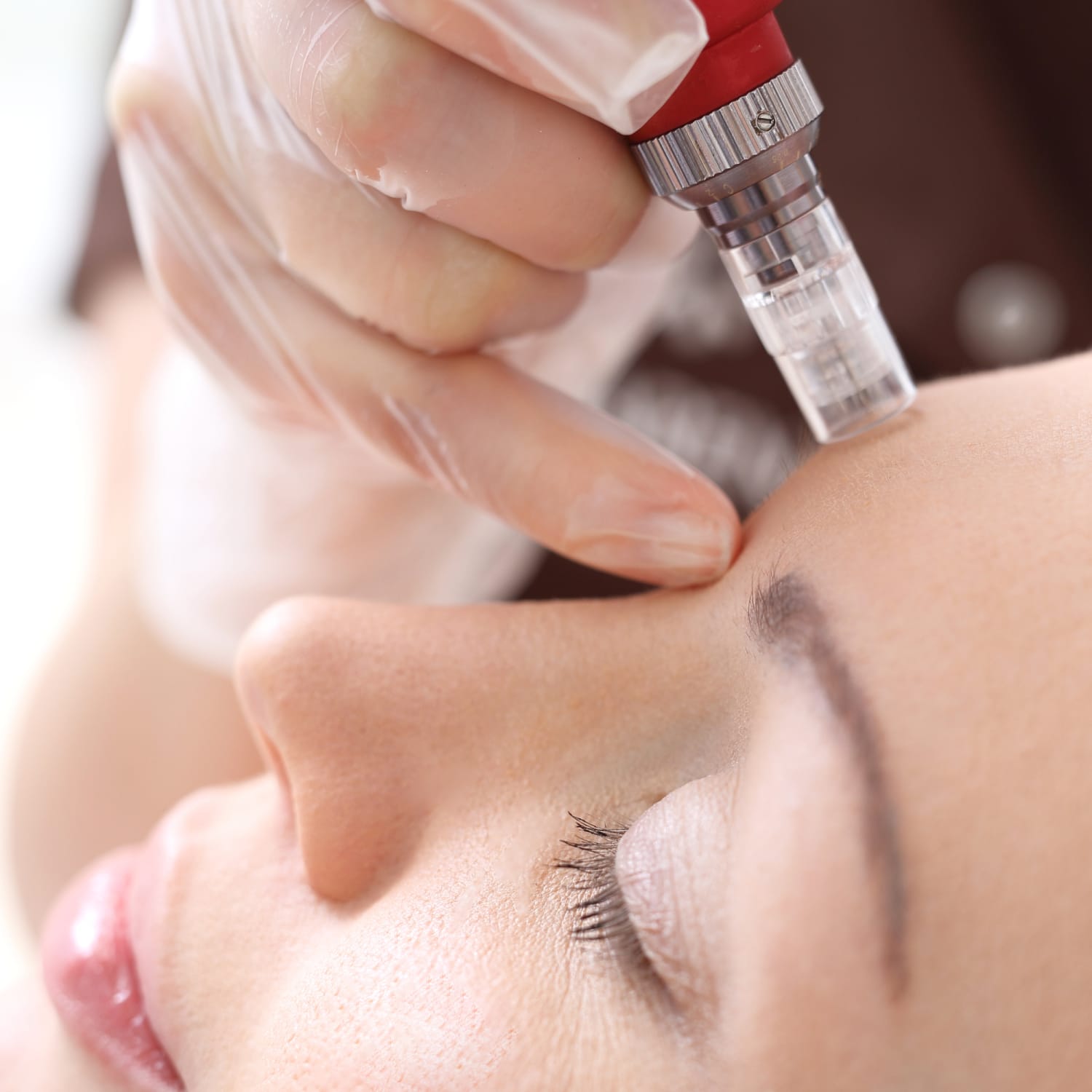 Microneedling Atlanta