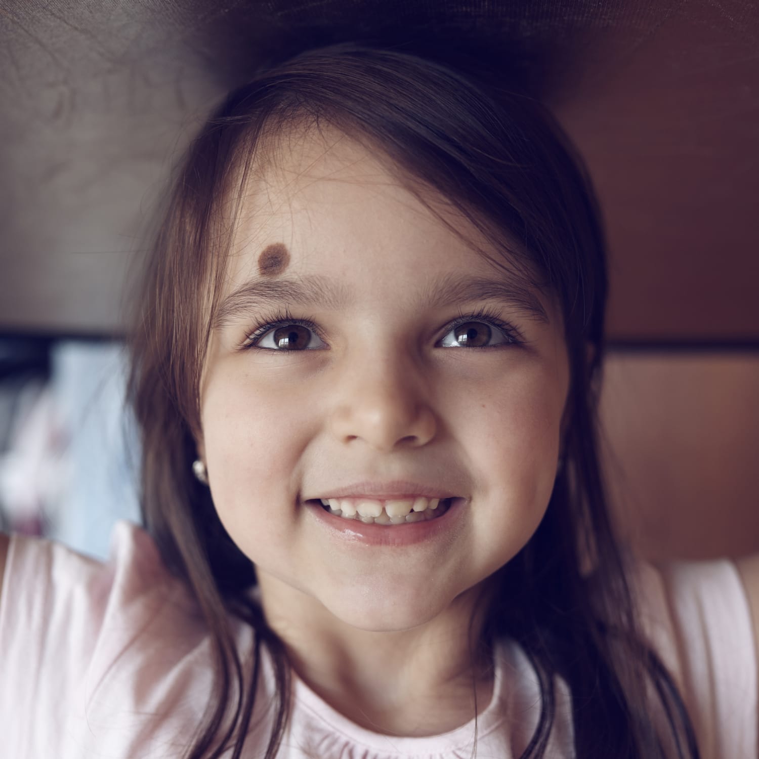 Birthmarks Fact Sheets Yale Medicine