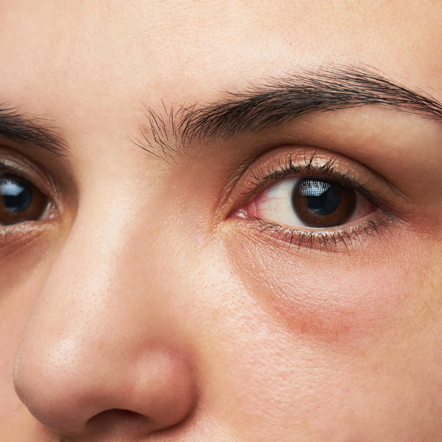 Темные круги под глазами женщин лечение. Глаза 3/4. Глаза отеки под глазами мешки. Малярные мешки.