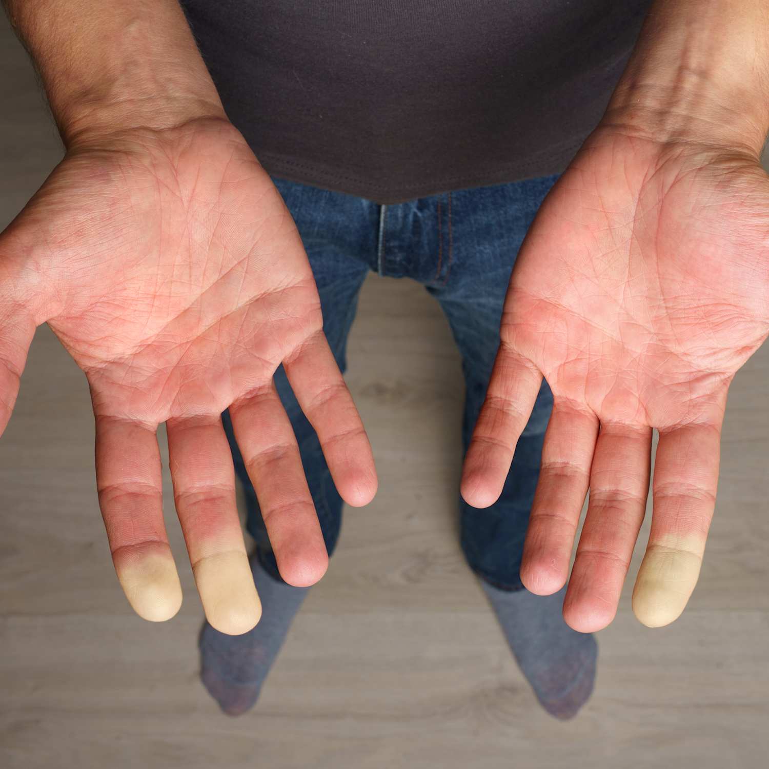 Raynaud Phenomenon | Fact Sheets | Yale Medicine