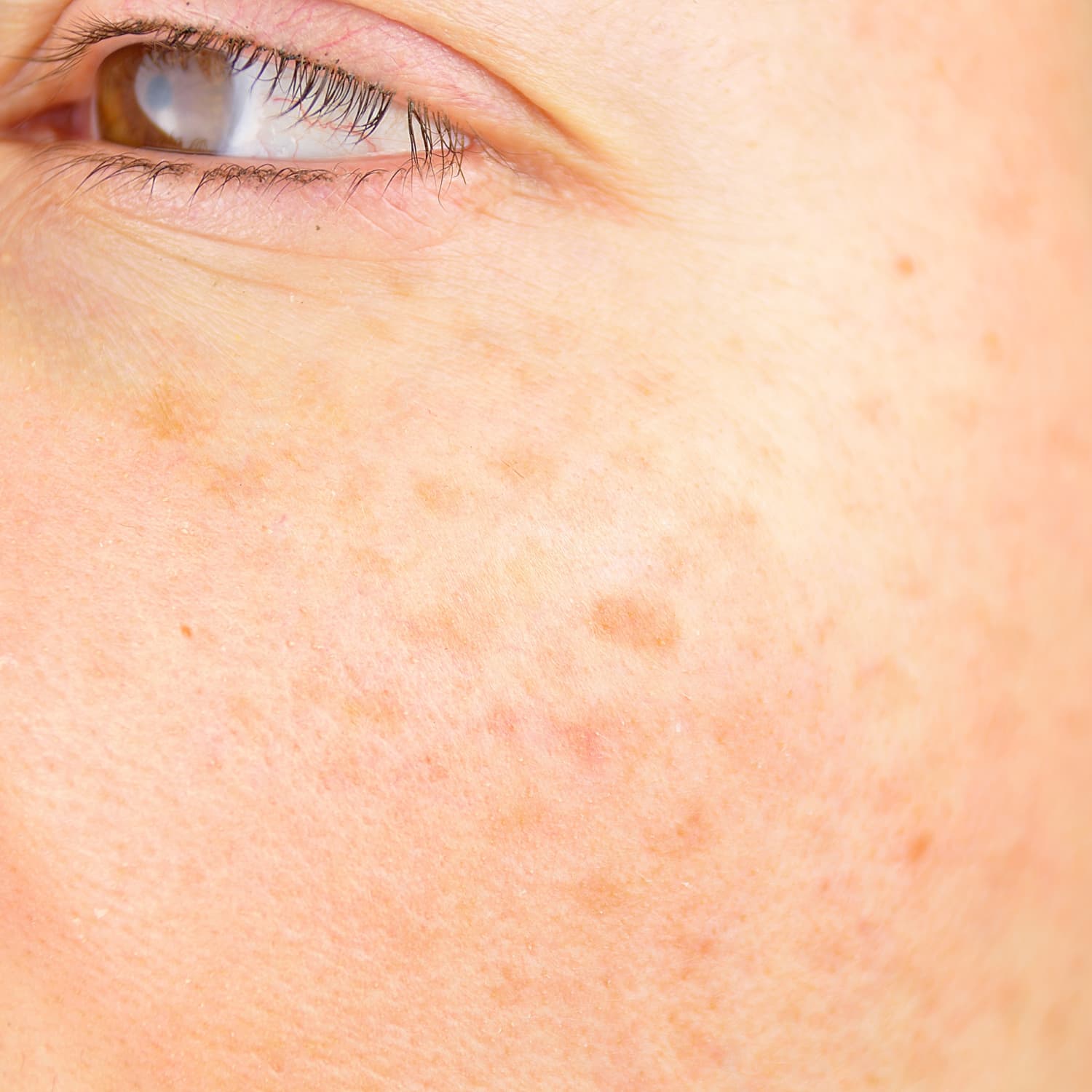 Sun damaged skin sale